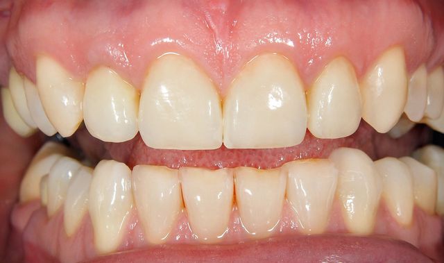 Smile Gallery - A2Z Dental - Before and After Photos